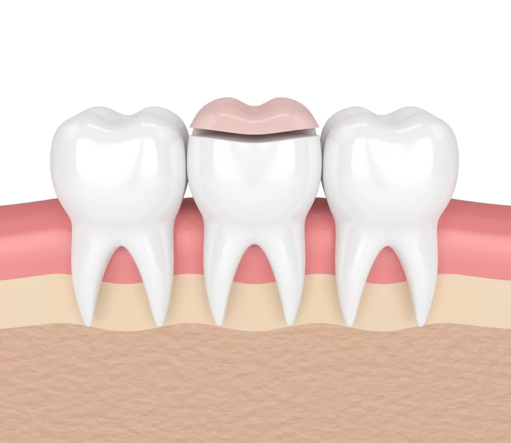 Cross-sectional view of three teeth, with the middle tooth having a dental inlay placed on it.