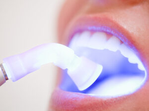 Close-up of a teeth whitening procedure using a LED light mouthpiece, illuminating the patient's open mouth with a soft purple light to enhance the whitening effect on teeth, showcasing an advanced cosmetic dental treatment.