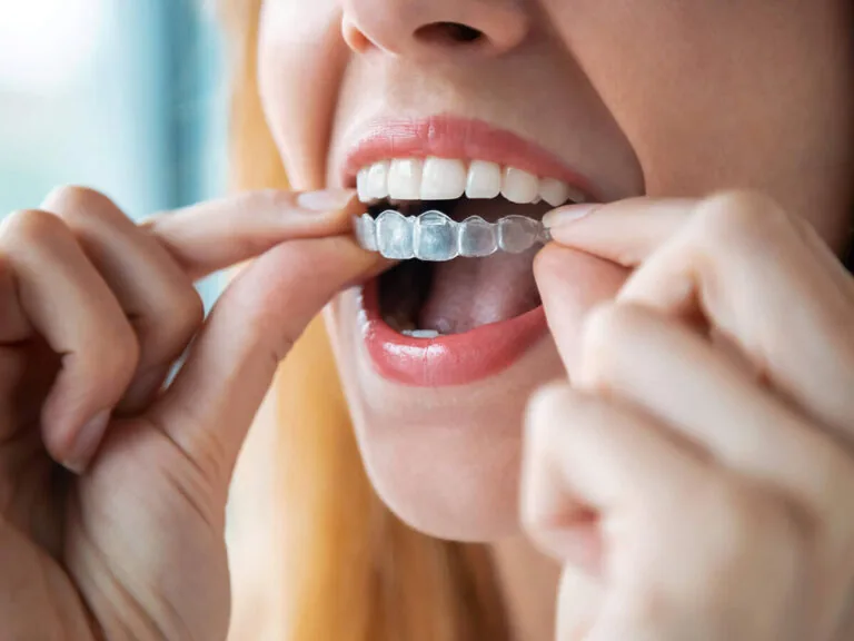 The image shows a person holding clear dental aligners with both hands. The person has light pink nail polish and is wearing a blue dental bib, suggesting a dental clinic setting.