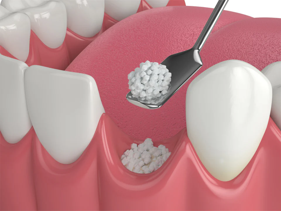 Dental bone grafting available at Family Dentistry of Lakewood in Lakewood, WA