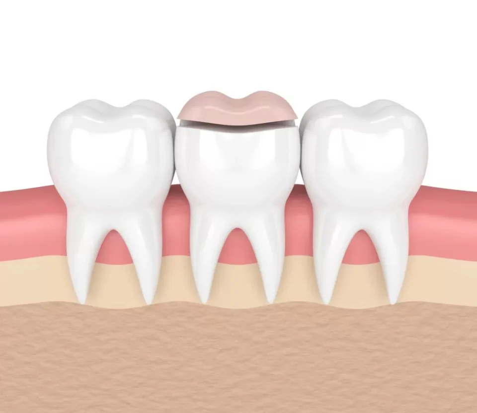Dental inlays and dental onlays available at Family Dentistry of Lakewood in Lakewood, WA