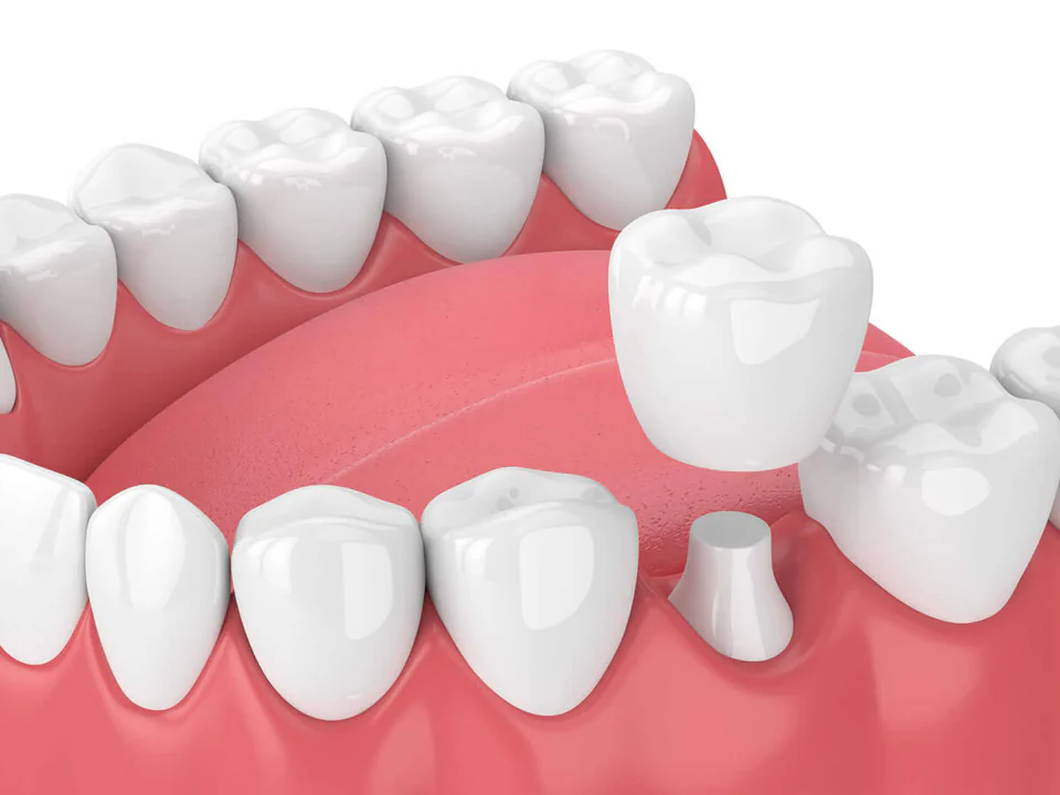 Dental crowns and dental bridges available at Family Dentistry of Lakewood in Lakewood, WA