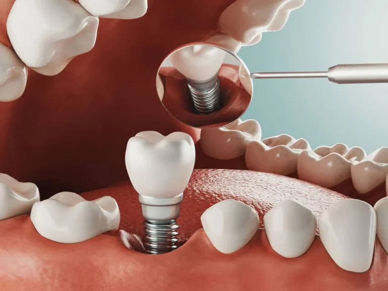 Dental implant services available at Family Dentistry of Lakewood in Lakewood, WA